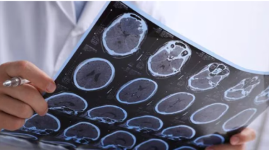 Detectan un sorprendente vínculo entre el ayuno intermitente y la enfermedad de Alzheimer